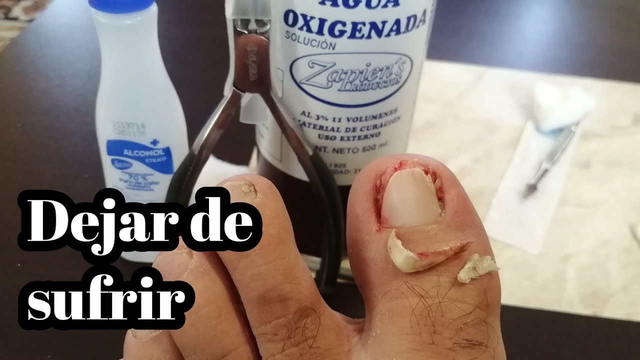 Como sacar una uña enterada fácil y rápido con hongo unicomicosis