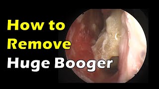 how to remove huge booger