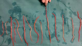 Doctors Remove 14 Roundworms From Woman