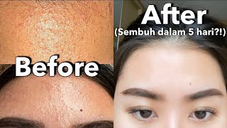 Download lagu BRUNTUSAN HILANG CUMAN PAKE 1 PRODUK AJA?! || CARA MENGHILANGKAN BRUNTUSAN DENGAN CEPAT mp3