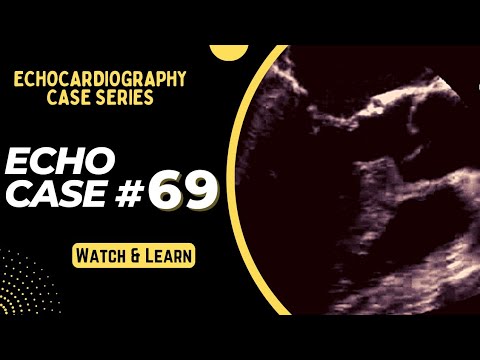 Echo Case 69: Echocardiography Spot Diagnosis Series