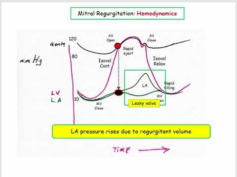 12DaysinMarch, Valvular Heart Disease#4, Mitral Regurgitation (Part I) for the USMLE Step One Exam