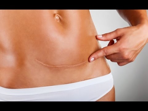 Sul valore della chirurgia dellanca Mal di schiena sopra la vita durante la gravidanza