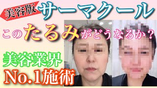 【デルマ サーモ クール】フェイスラインがグッと変わります