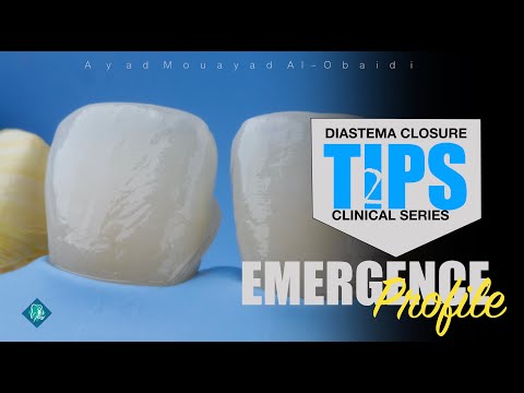 Diastema Closure Technique Tips