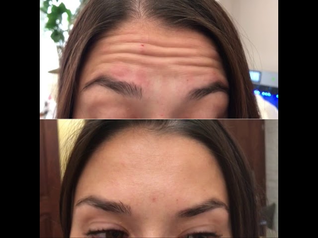 Коррекция морщин ботоксом