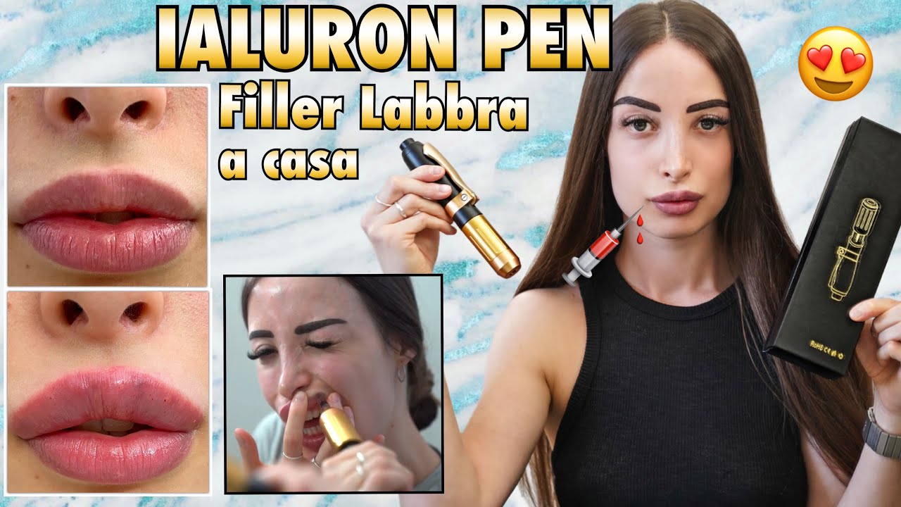Watch Now 🇮🇹 FILLER LABBRA A CASA 💉 IALURON PEN 👄 Auto iniezione di acido ialuronico a casa 🇮🇹 FILLER LABBRA A CASA 💉 IALURON PEN 👄 Auto iniezione di acido ialuronico a casa