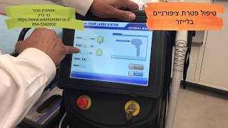 טיפול פטרת ציפורניים בלייזר
