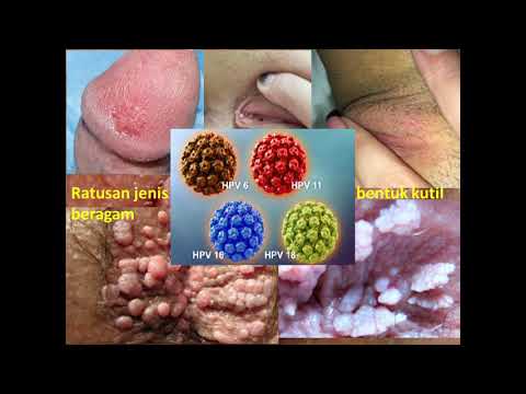 genitális hpv a kezeken vestibularis papillomatosis fáj