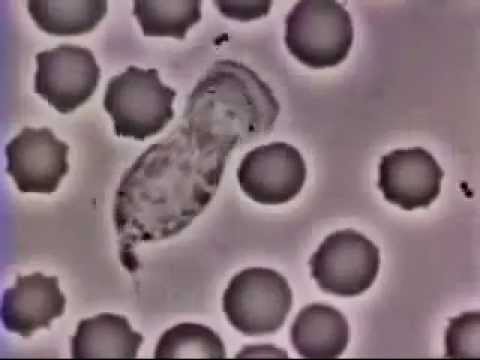 Riabilitazione dopo il cancro alla prostata Un farmaco per il trattamento delle cisti della ghiandola prostatica