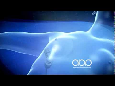 Breast Augmentation Surgery in India