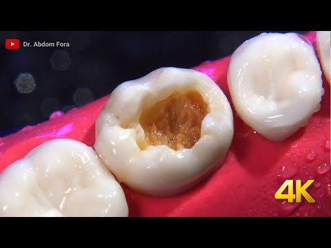 Beautifully Done Dental Restoration