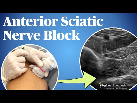 Ultrasound-Guided Anterior Sciatic Nerve Block