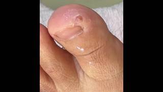 Ep_8793 Big ingrown toenail removal 👣 อุ้ย..จะทะลุไหมหนอ 😅 (clip from Thailand)