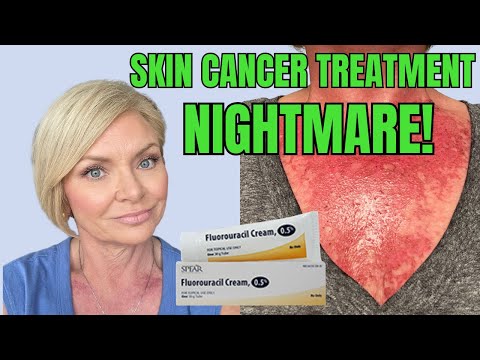 THE UGLY TRUTH ABOUT SKIN CANCER: My Fluorouracil Treatment Journey
