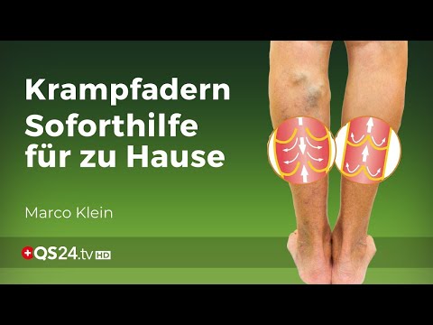 Kleinsche Felder erfolgreich gegen Krampfadern & Besenreiser|@QS24