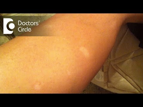 What causes sudden appearance of white round spots on legs? - Dr. Sudheendra Udbalker
