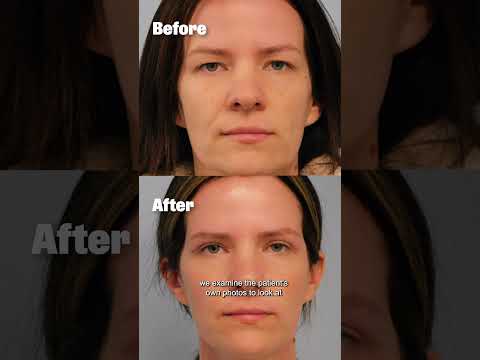 Dr. Pontell & Dr. Weng on Bradley Cooper's possible bleph 👀