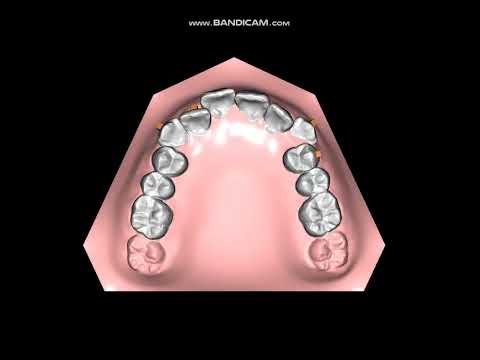 How Invisalign Works?