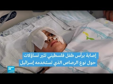 إصابة برأس طفل فلسطيني تثير تساؤلات حول نوع الرصاص الذي تستخدمه إسرائيل