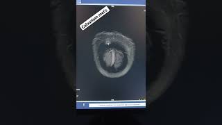 calvarium met&#39;s mri Brain contrast case