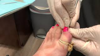 Ingrown Toenail Removal Surgery Video - Cosmetic outcome