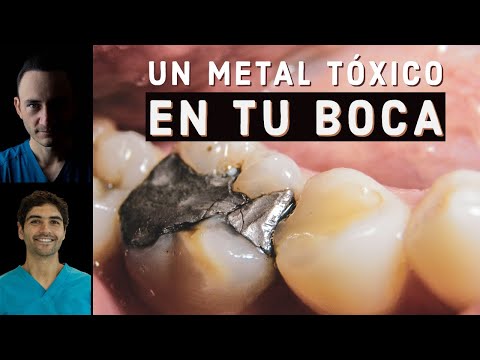 ¿Tienes Amalgamas En Los Dientes? Sácalas De Inmediato