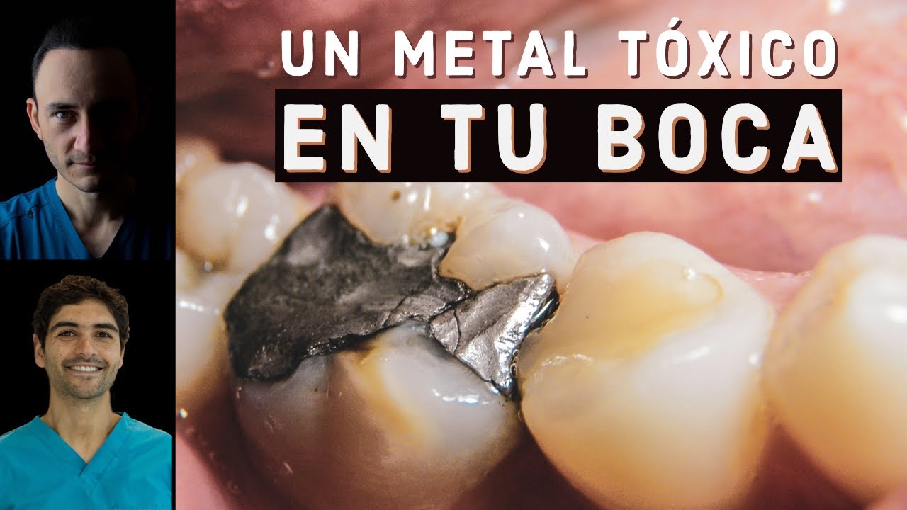 Watch ¿La amalgama dental es tóxica Dentista biológico nos explica. Now ¿La amalgama dental es tóxica Dentista biológico nos explica.