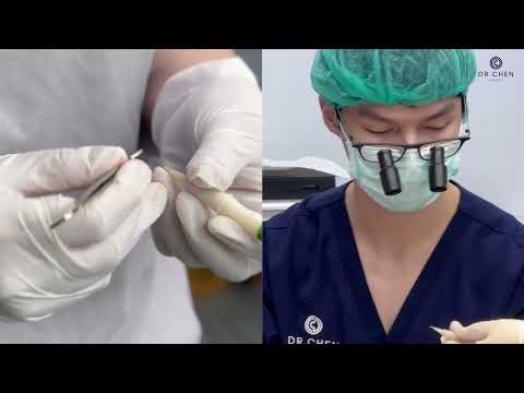 ปลูกผมที่ Dr.Chen Clinic