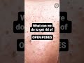 Open Pores को कम करने के लिए किन बातो का ध्यान रखे | #openpores #youtubeshorts #shorts