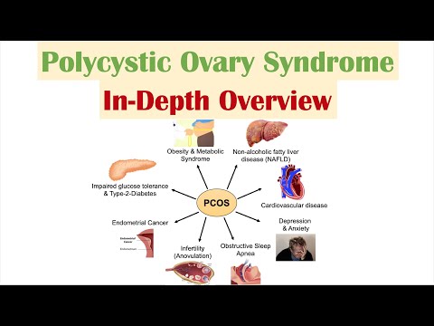 Polycystic Ovary Syndrome (PCOS) | Overview of Associated Conditions, Diagnosis & Treatments