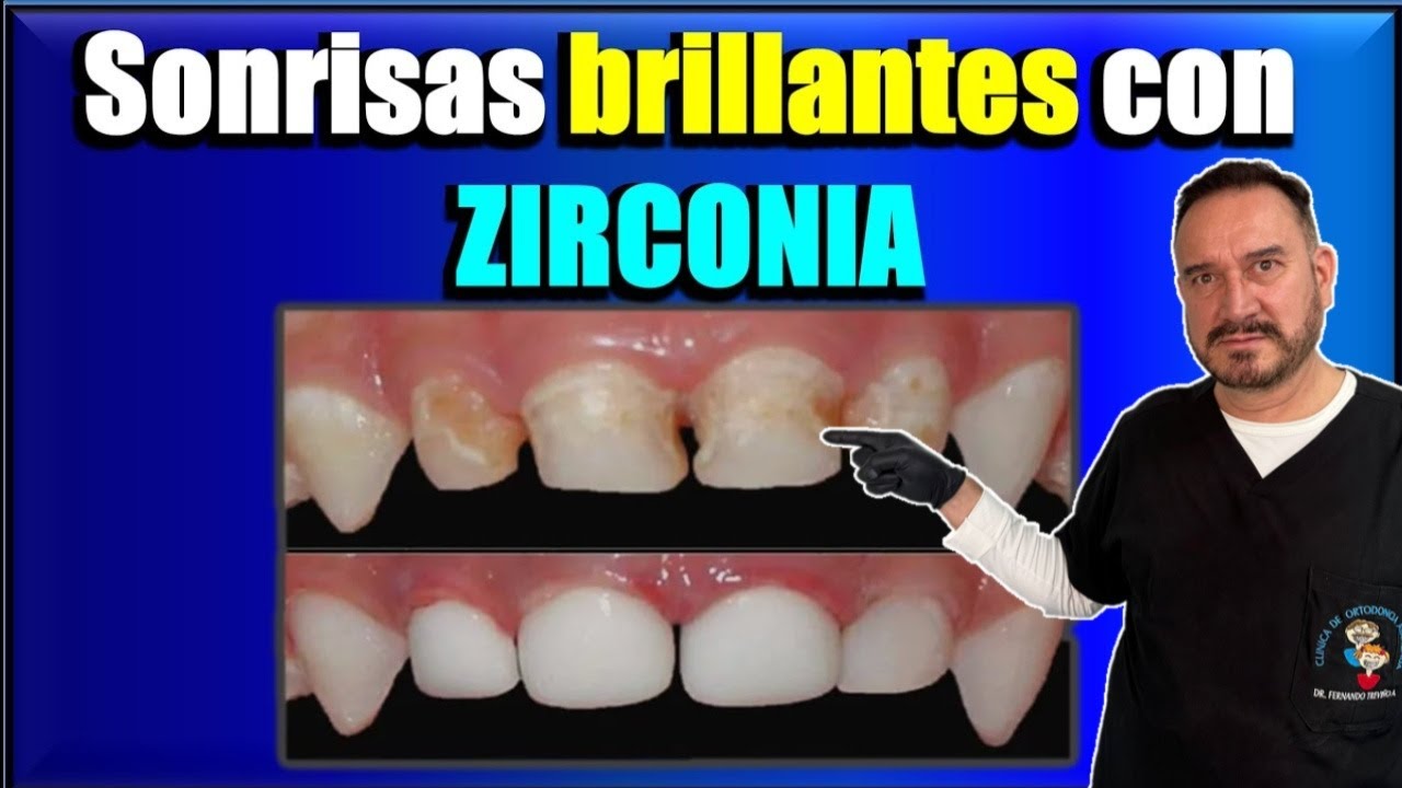 Watch CORONAS DENTALES ESTETICAS DE ZIRCONIA EN ODONTOPEDIATRIA Now CORONAS DENTALES ESTETICAS DE ZIRCONIA EN ODONTOPEDIATRIA