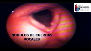 NÓDULOS DE CUERDAS VOCALES