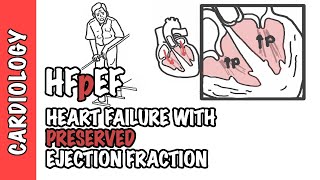 HFpEF - Heart Failure with Preserved Ejection Fraction