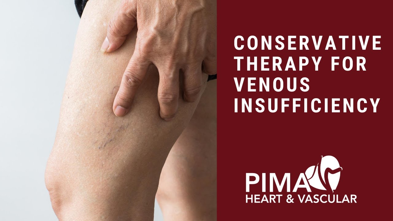 4 Conservative Treatment Options for Venous Insufficiency