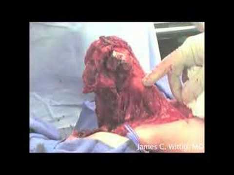 Osteosarcoma Resection Of The Humerus Proximal End - Part 3/6