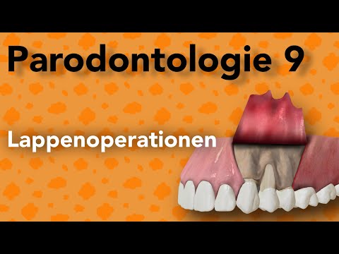 Parodontologie 9 -  Lappenoperationen
