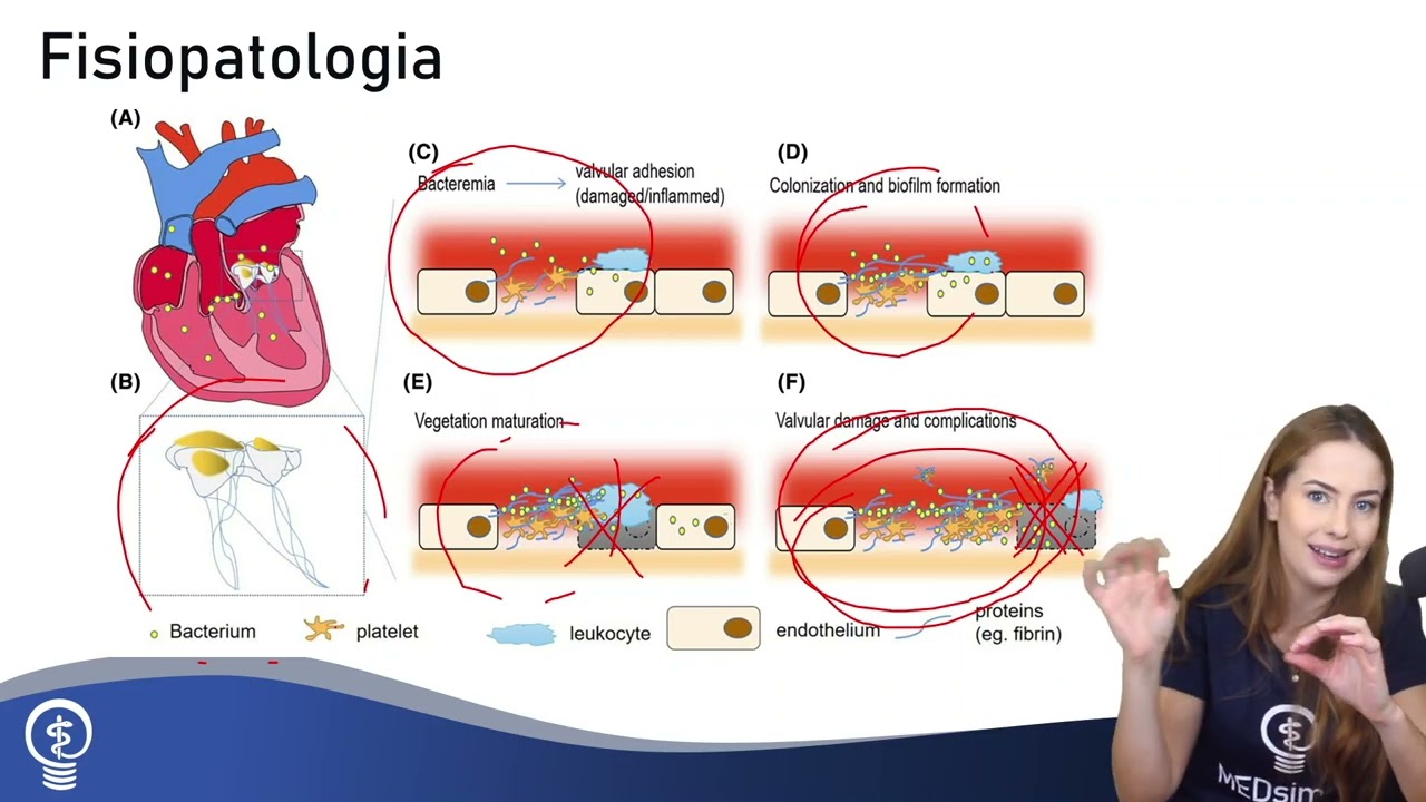 Endocardite Infecciosa