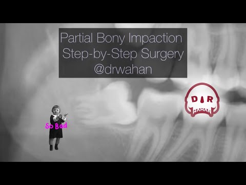 Step-by-Step Partial Bony Impacted Wisdom Tooth Extraction