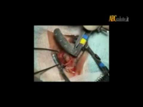 Eventuali iniezioni nel ginocchio con farmaci osteoartrite Iniezioni di silicone nellarticolazione del ginocchio