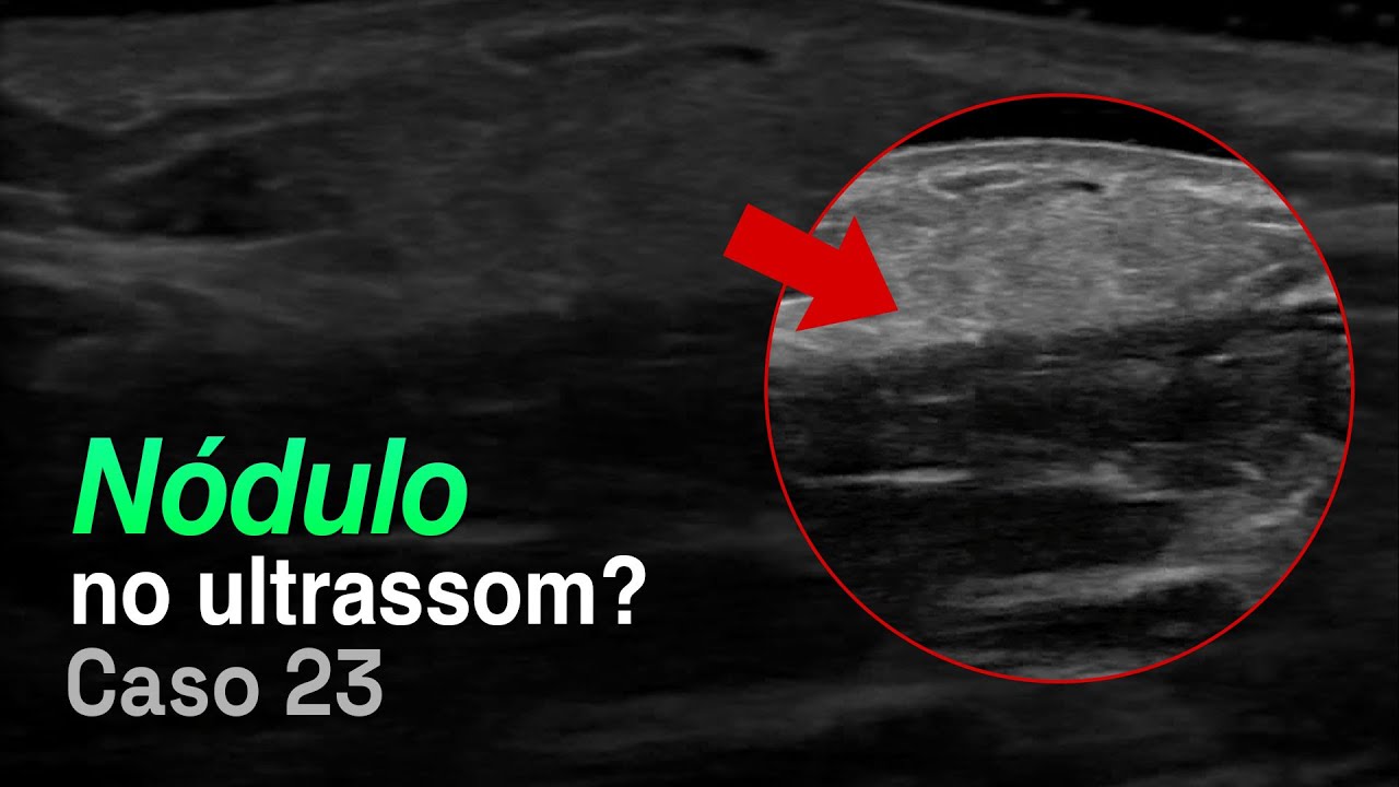 Ultrassom do Antebraço: Nódulo? Veja esse Diagnóstico | Caso 023 - MSKD