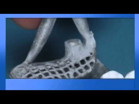 Vidéo Rhein 83 OT Cap Extracoronal Attachments