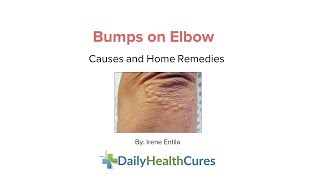 Bumps on Elbows: Itchy and Non-Itchy Bumps, Causes, Home Remedies