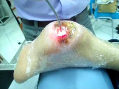 Cibo a un osteocondrosi della colonna cervicale-toracica Dolore alle costole da dietro