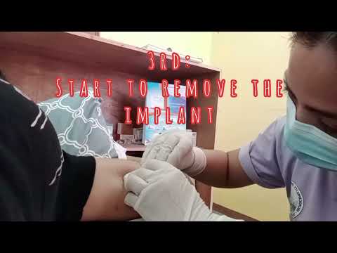 IMPLANT REMOVAL AND INSERTION