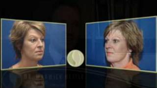 Dr Nettle Of Silkwood Medical Talks About Blepharoplasty (Eyelid Surgery)