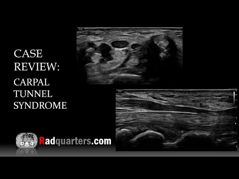 Ultrasound of Carpal Tunnel Syndrome
