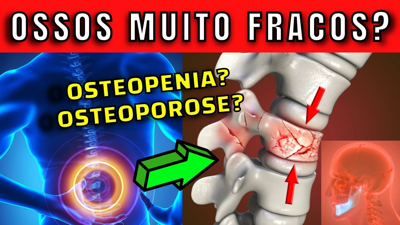 5 TIPS TO AVOID OSTEOPENIA and OSTEOPOROSIS (and symptoms of weak bones)