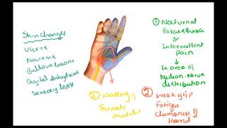 Carpal tunnel syndrome – Pain in hand