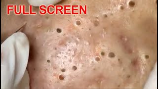 LARGE Blackheads Removal - Best Pimple Popping Vid